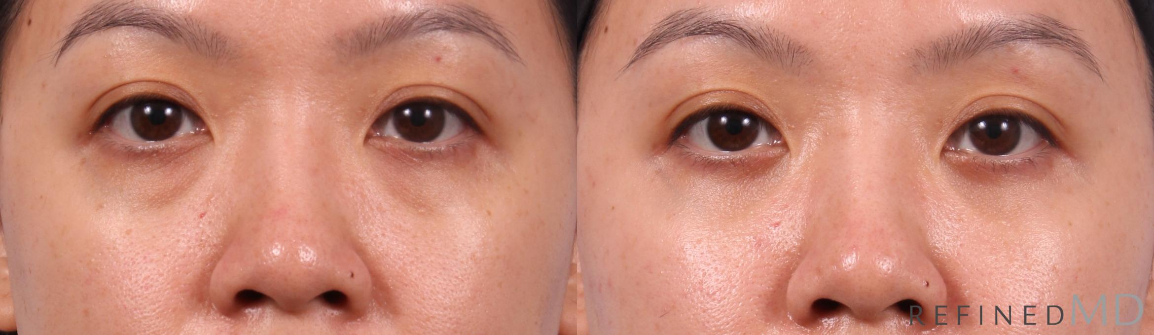 Before & After Eyelid Case 1150 Front View in Los Gatos & San Jose, CA