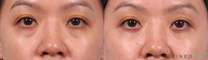 Before & After Eyelid Case 1150 Front View in Los Gatos & San Jose, CA