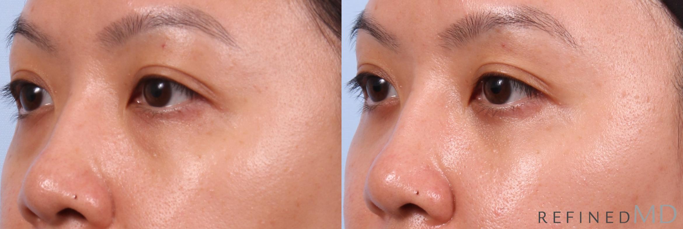 Before & After Eyelid Case 1150 Left Oblique View in Los Gatos & San Jose, CA