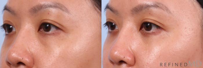 Before & After Eyelid Case 1150 Left Oblique View in Los Gatos & San Jose, CA
