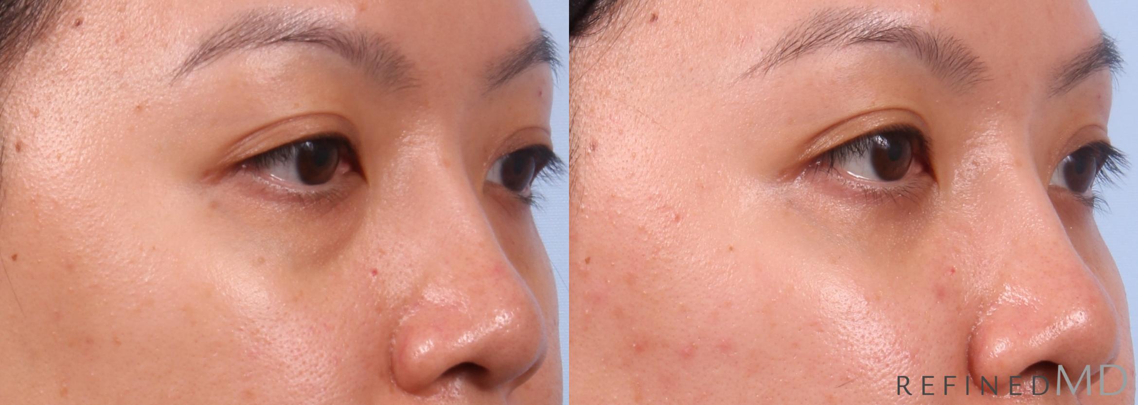 Before & After Eyelid Case 1150 Right Oblique View in Los Gatos & San Jose, CA