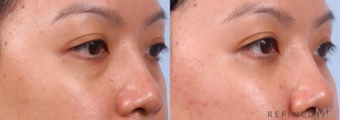Before & After Eyelid Case 1150 Right Oblique View in Los Gatos & San Jose, CA