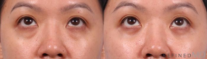 Before & After Eyelid Case 1150 Up Gaze View in Los Gatos & San Jose, CA