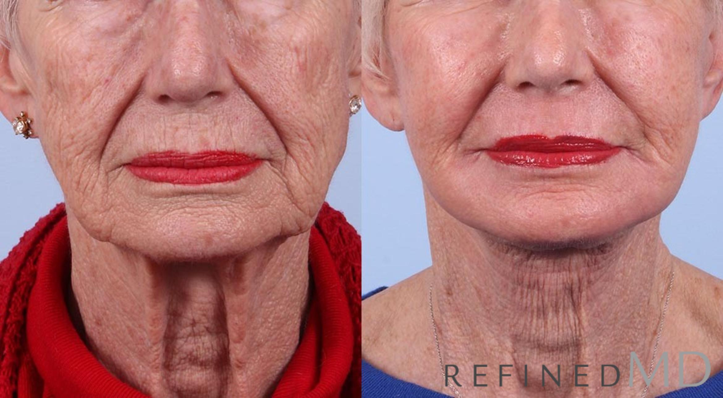 Before & After Facelift Case 1000 View 1 View in Los Gatos & San Jose, CA