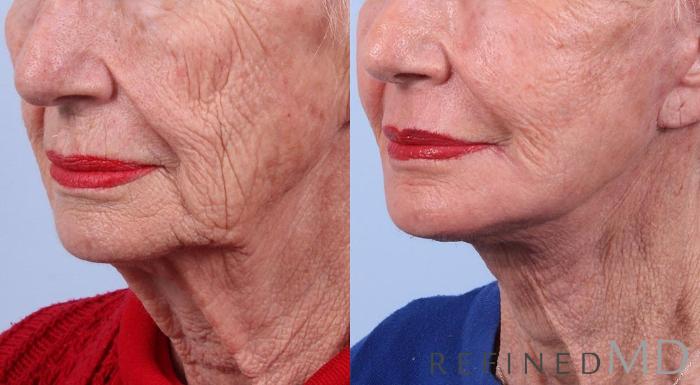 Before & After Facelift Case 1000 View 2 View in Los Gatos & San Jose, CA