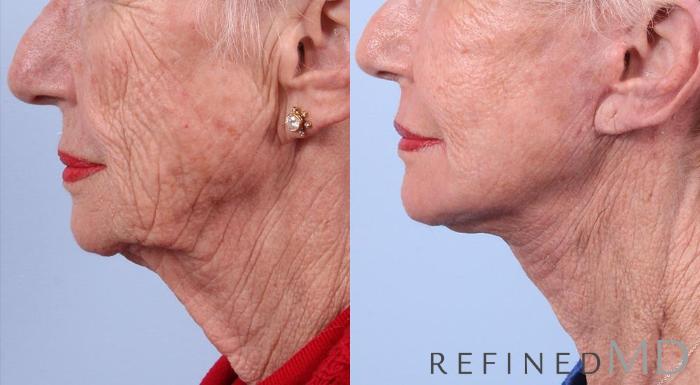 Before & After Facelift Case 1000 View 3 View in Los Gatos & San Jose, CA