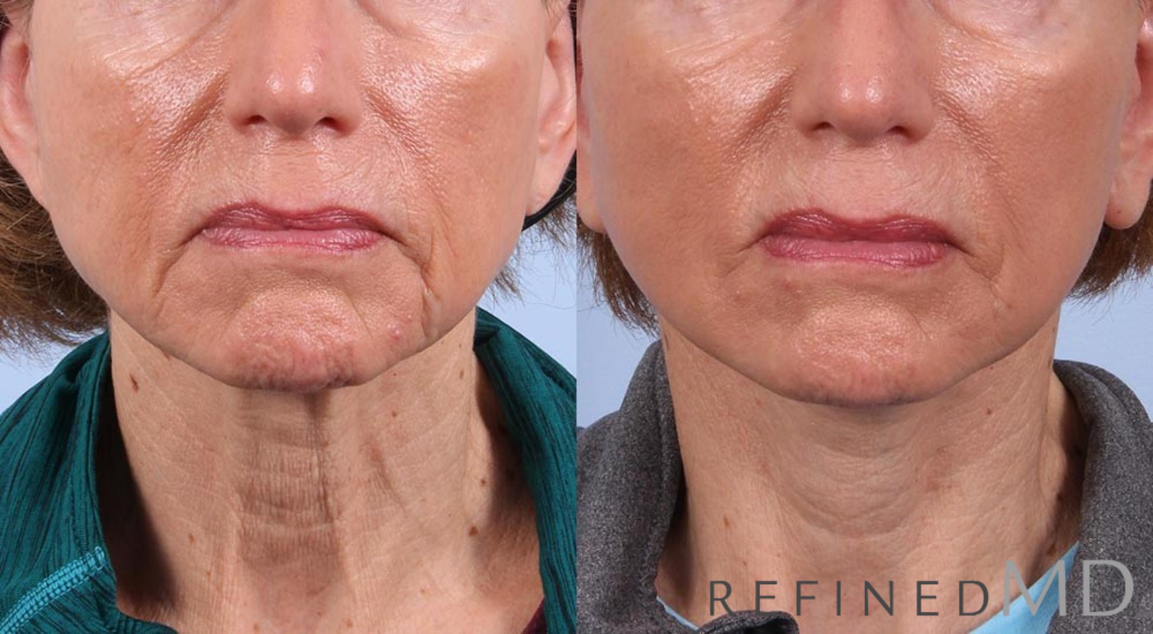 Before & After Facelift Case 1001 View 1 View in Los Gatos & San Jose, CA