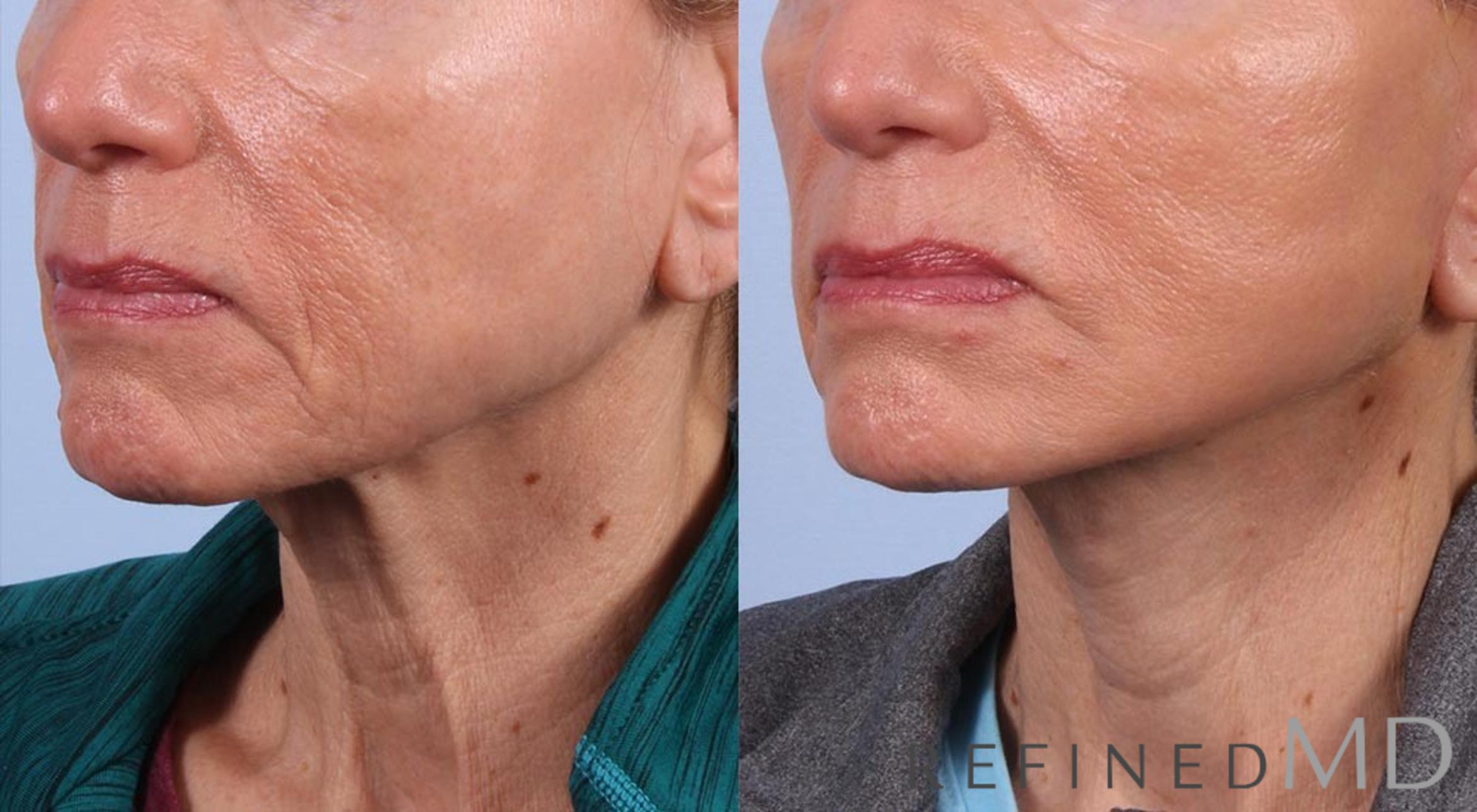 Before & After Facelift Case 1001 View 2 View in Los Gatos & San Jose, CA
