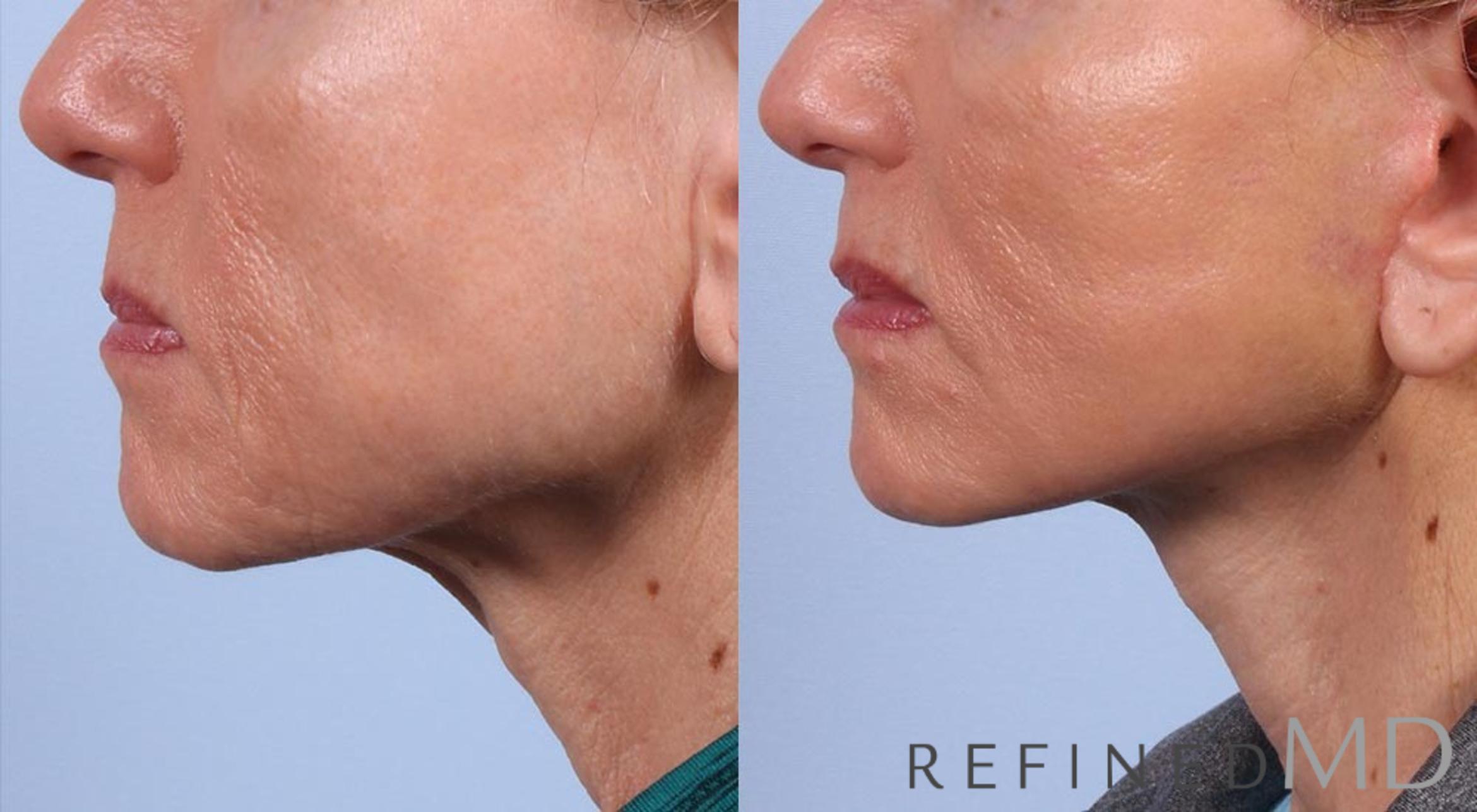 Before & After Facelift Case 1001 View 3 View in Los Gatos & San Jose, CA