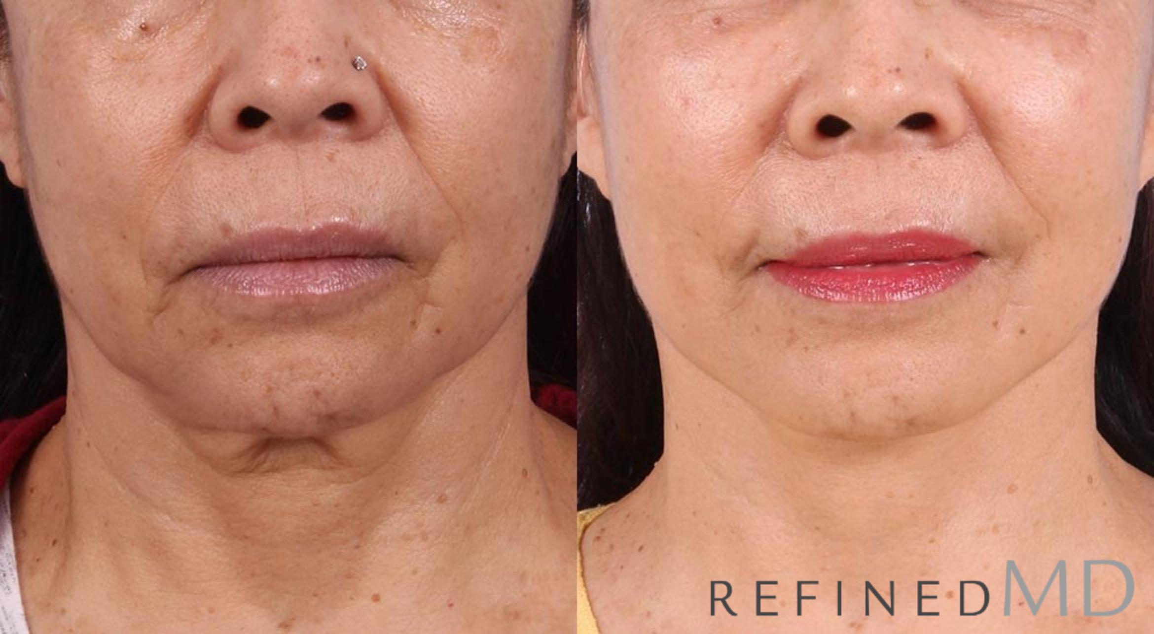 Before & After Facelift Case 1002 View 1 View in Los Gatos & San Jose, CA