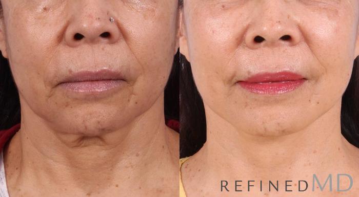 Before & After Facelift Case 1002 View 1 View in Los Gatos & San Jose, CA