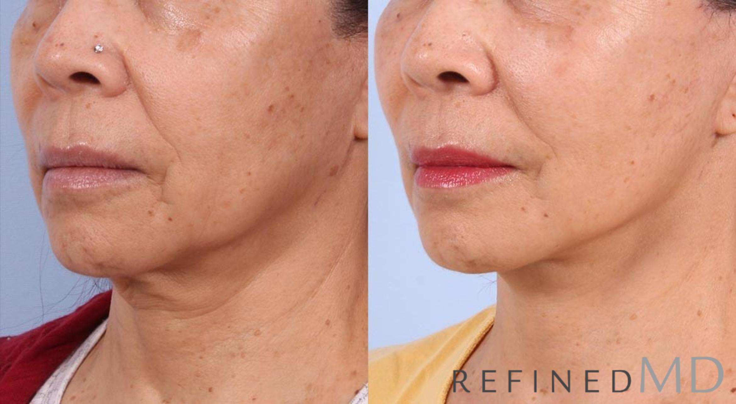 Before & After Facelift Case 1002 View 2 View in Los Gatos & San Jose, CA