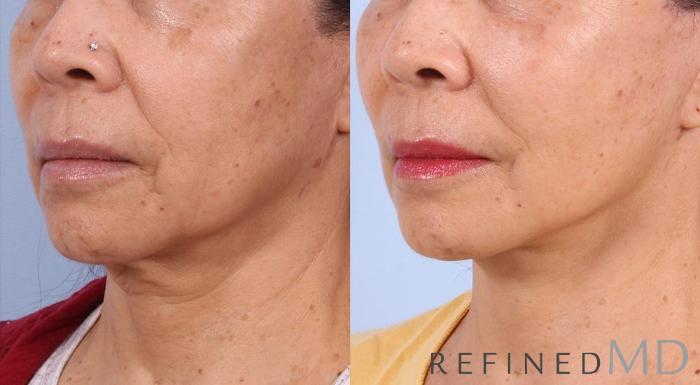 Before & After Facelift Case 1002 View 2 View in Los Gatos & San Jose, CA