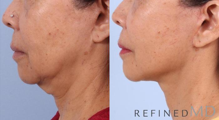 Before & After Facelift Case 1002 View 3 View in Los Gatos & San Jose, CA