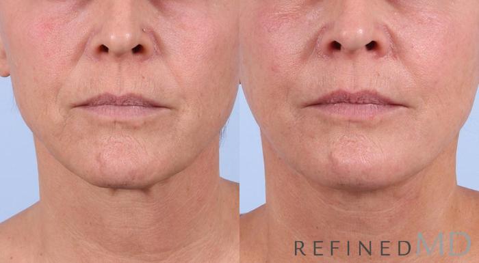 Before & After Facelift Case 1003 View 1 View in Los Gatos & San Jose, CA