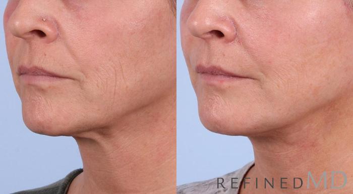 Before & After Facelift Case 1003 View 2 View in Los Gatos & San Jose, CA