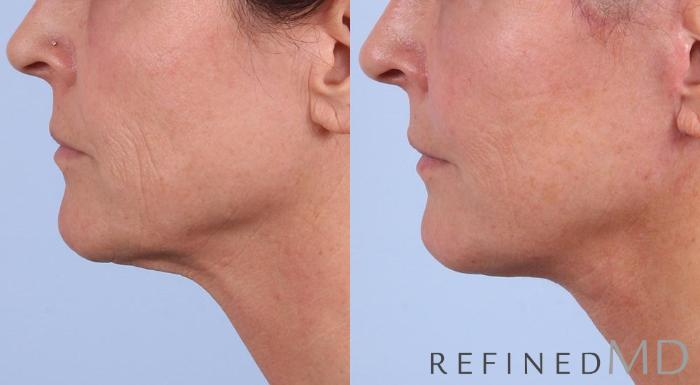 Before & After Facelift Case 1003 View 3 View in Los Gatos & San Jose, CA
