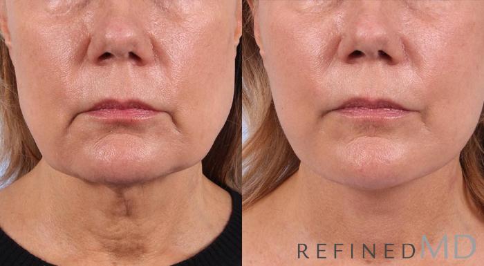 Before & After Facelift Case 1004 View 1 View in Los Gatos & San Jose, CA