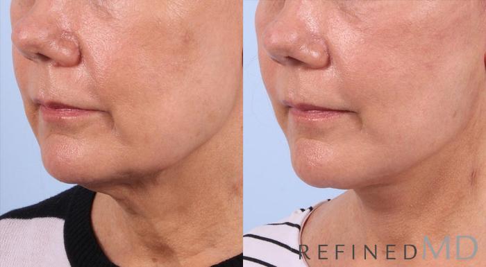 Before & After Facelift Case 1004 View 2 View in Los Gatos & San Jose, CA