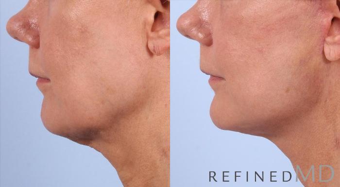 Before & After Facelift Case 1004 View 3 View in Los Gatos & San Jose, CA