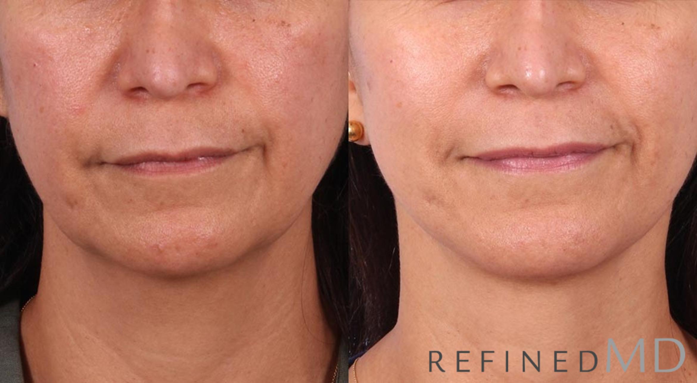 Before & After Facelift Case 1005 View 1 View in Los Gatos & San Jose, CA