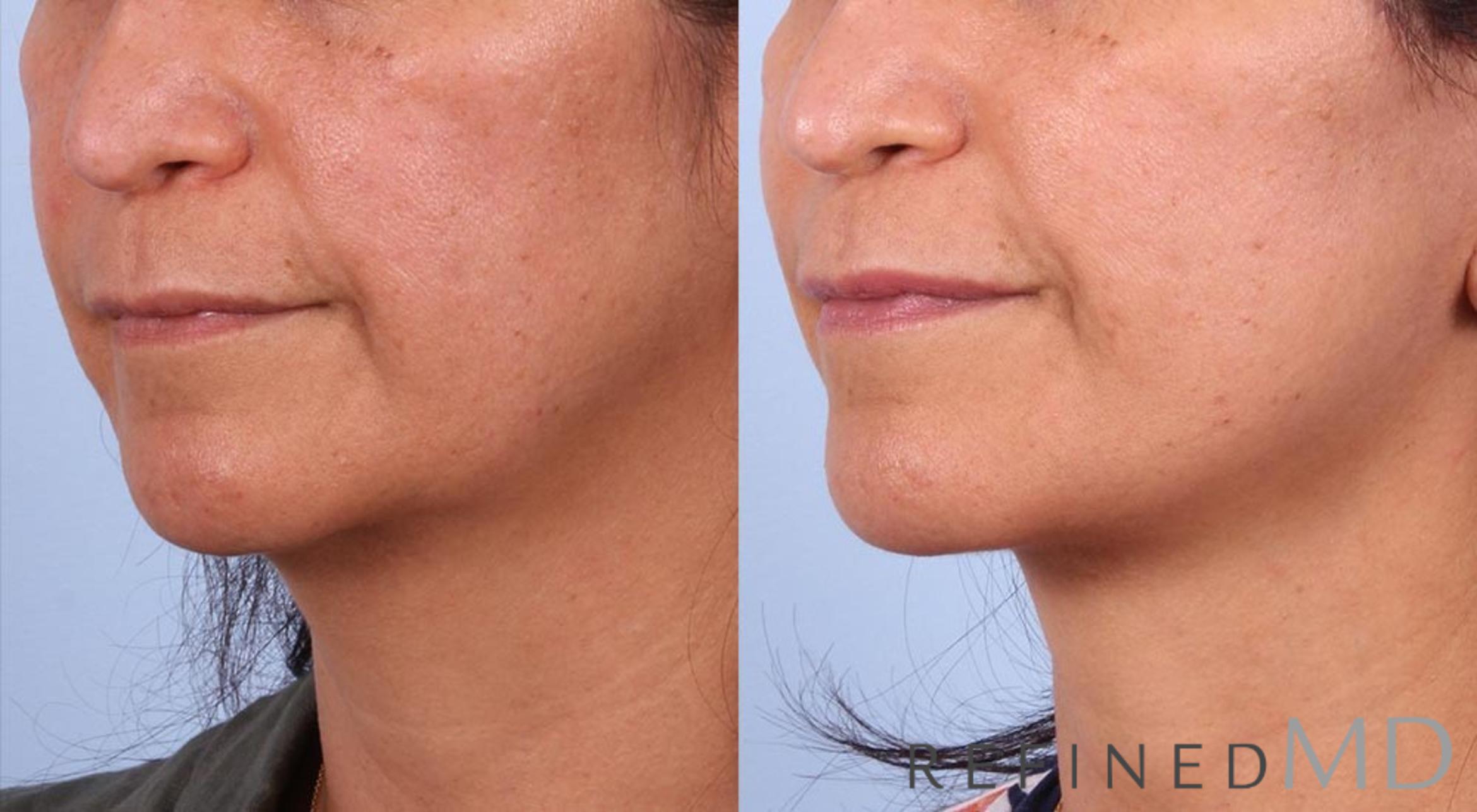 Before & After Facelift Case 1005 View 2 View in Los Gatos & San Jose, CA