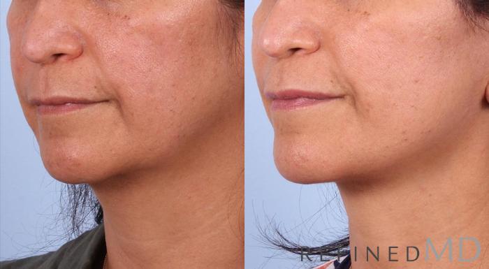 Before & After Facelift Case 1005 View 2 View in Los Gatos & San Jose, CA