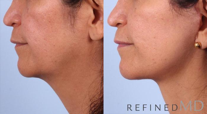 Before & After Facelift Case 1005 View 3 View in Los Gatos & San Jose, CA