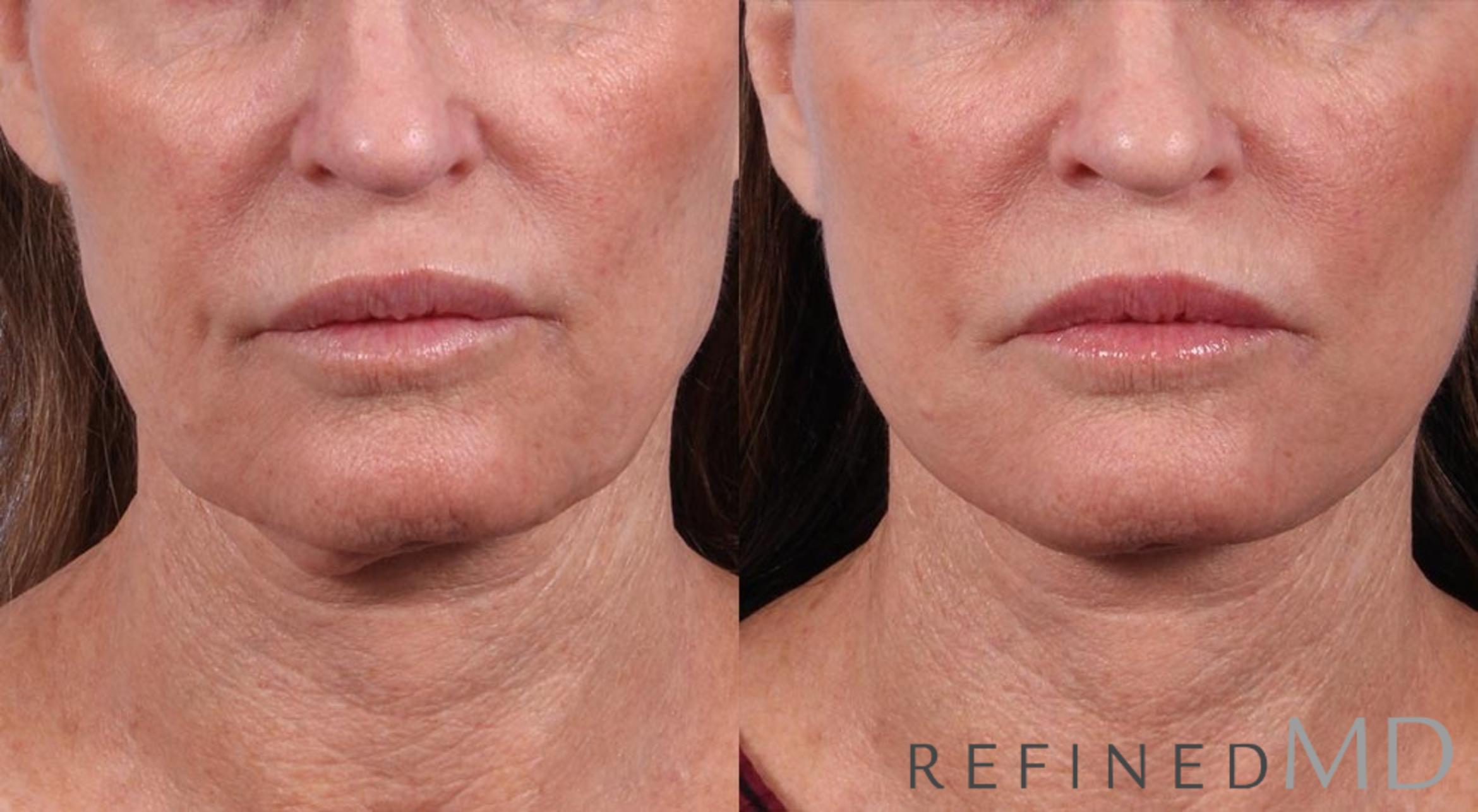 Before & After Facelift Case 1006 View 1 View in Los Gatos & San Jose, CA