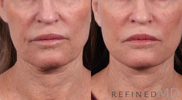Before & After Facelift Case 1006 View 1 View in Los Gatos & San Jose, CA