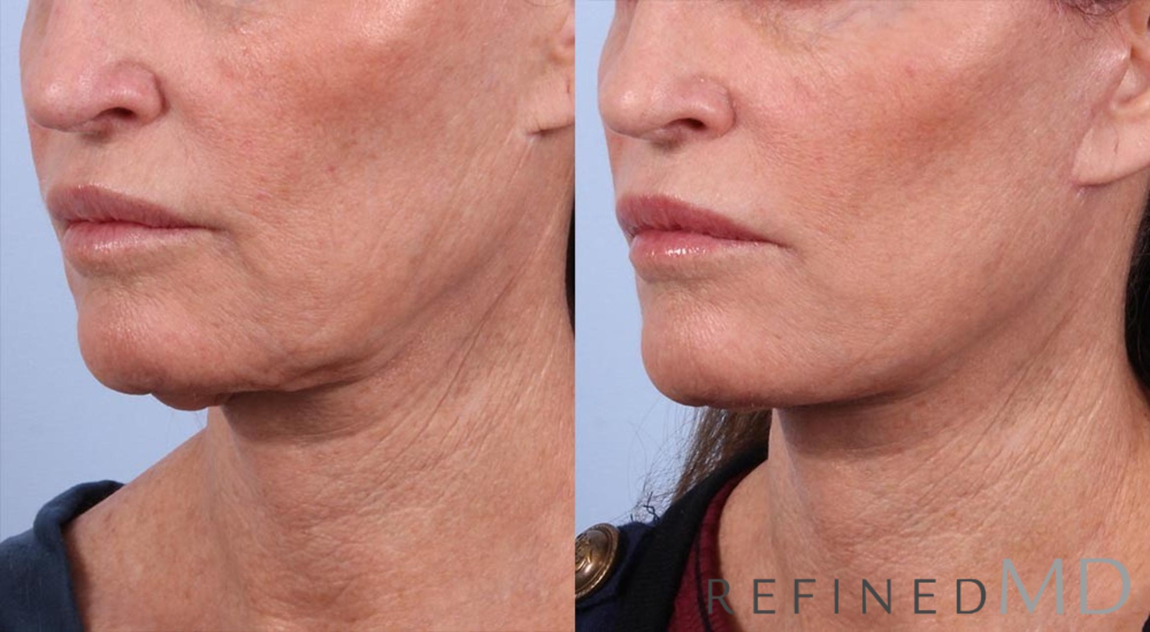 Before & After Facelift Case 1006 View 2 View in Los Gatos & San Jose, CA