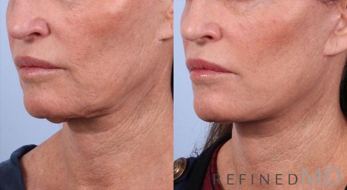 Before & After Facelift Case 1006 View 2 View in Los Gatos & San Jose, CA