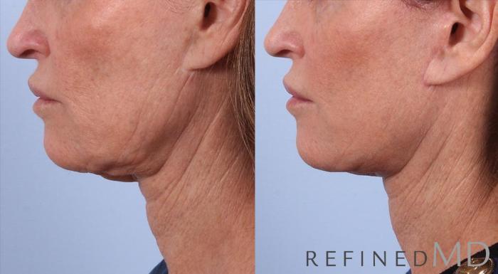 Before & After Facelift Case 1006 View 3 View in Los Gatos & San Jose, CA