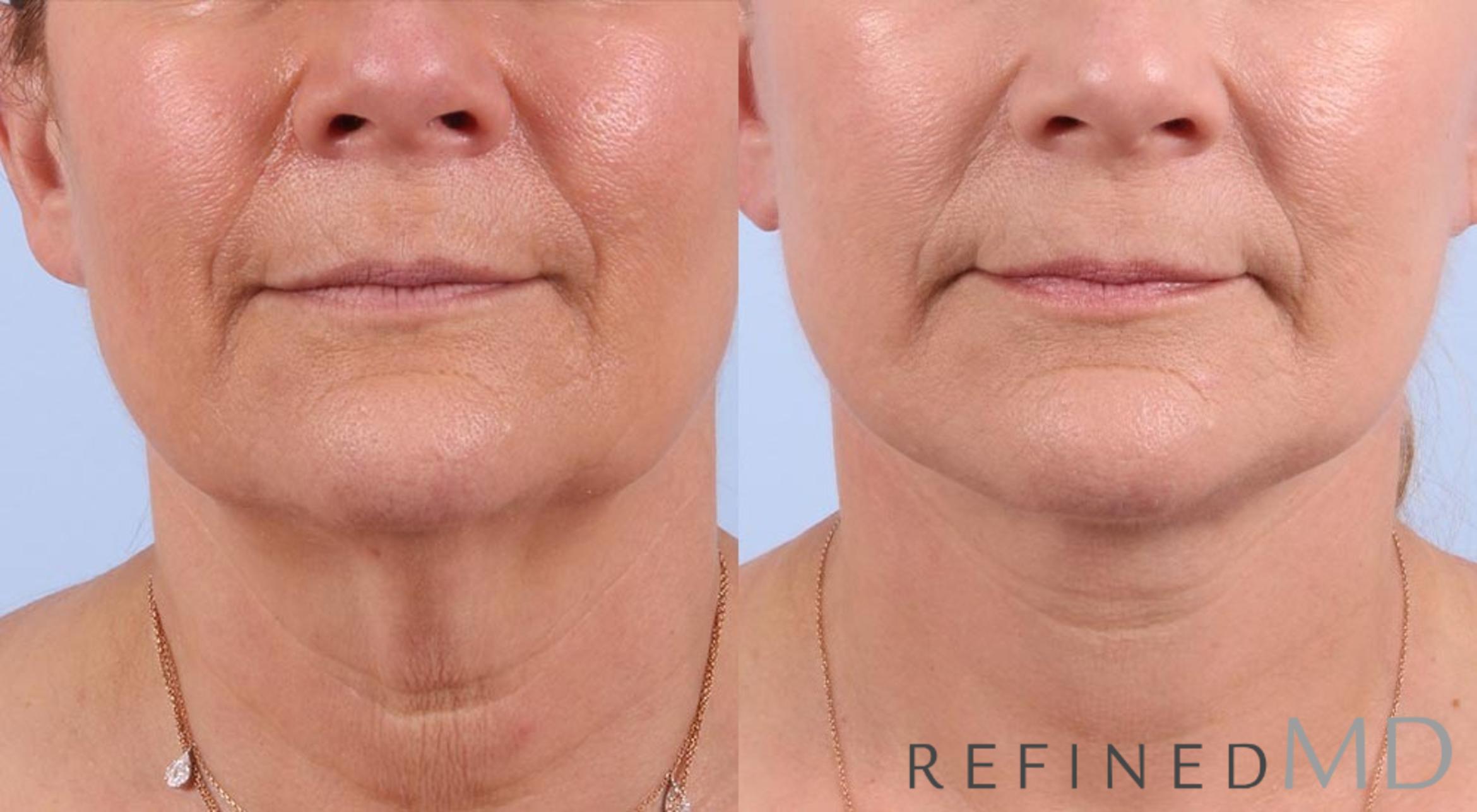 Before & After Facelift Case 1007 View 1 View in Los Gatos & San Jose, CA
