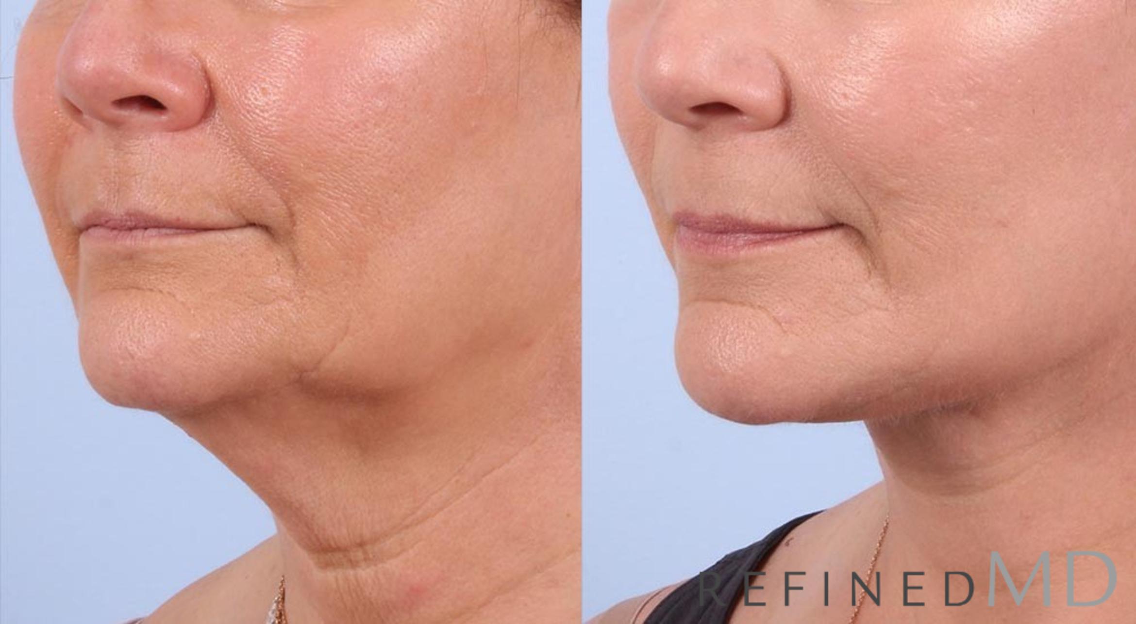 Before & After Facelift Case 1007 View 2 View in Los Gatos & San Jose, CA