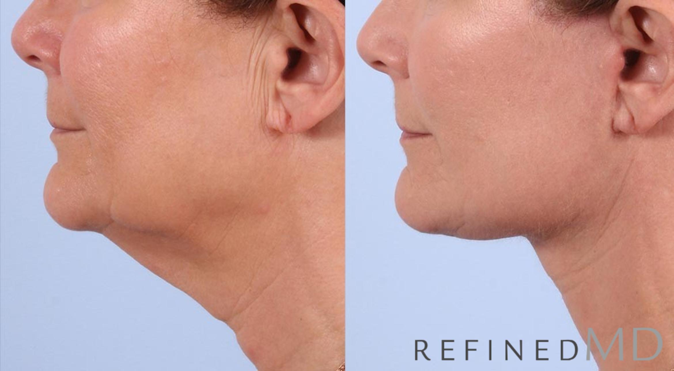 Before & After Facelift Case 1007 View 3 View in Los Gatos & San Jose, CA