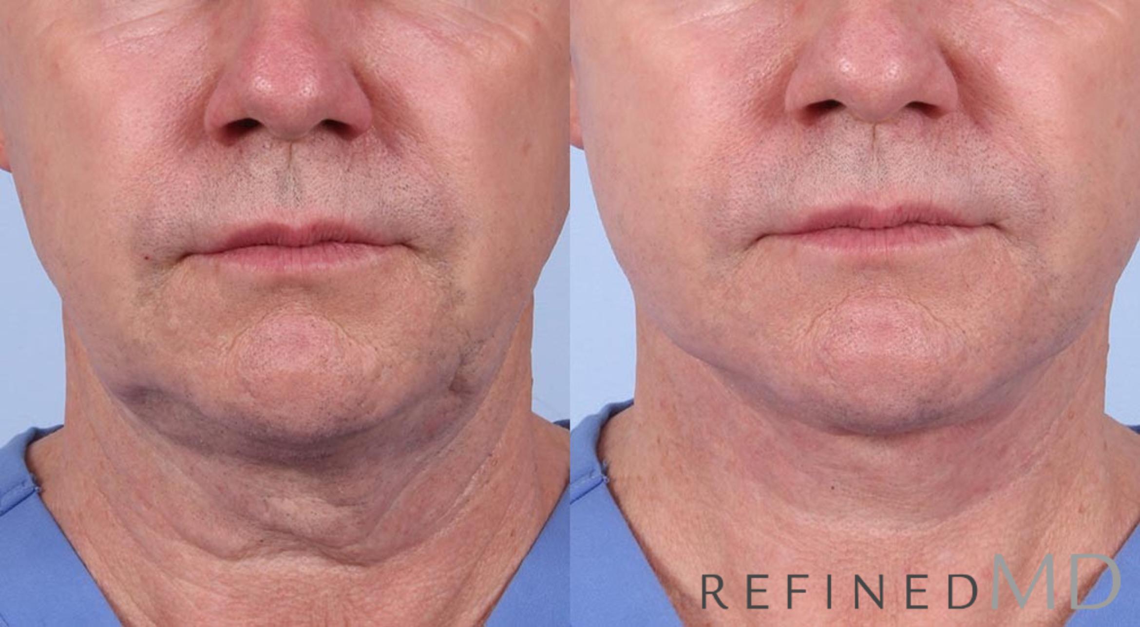 Before & After Facelift Case 1008 View 1 View in Los Gatos & San Jose, CA