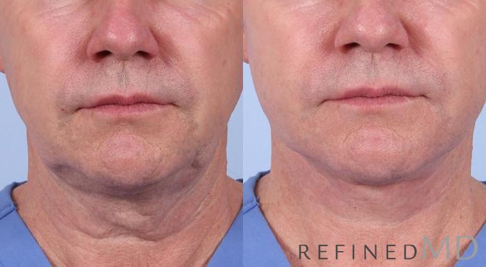Before & After Facelift Case 1008 View 1 View in Los Gatos & San Jose, CA