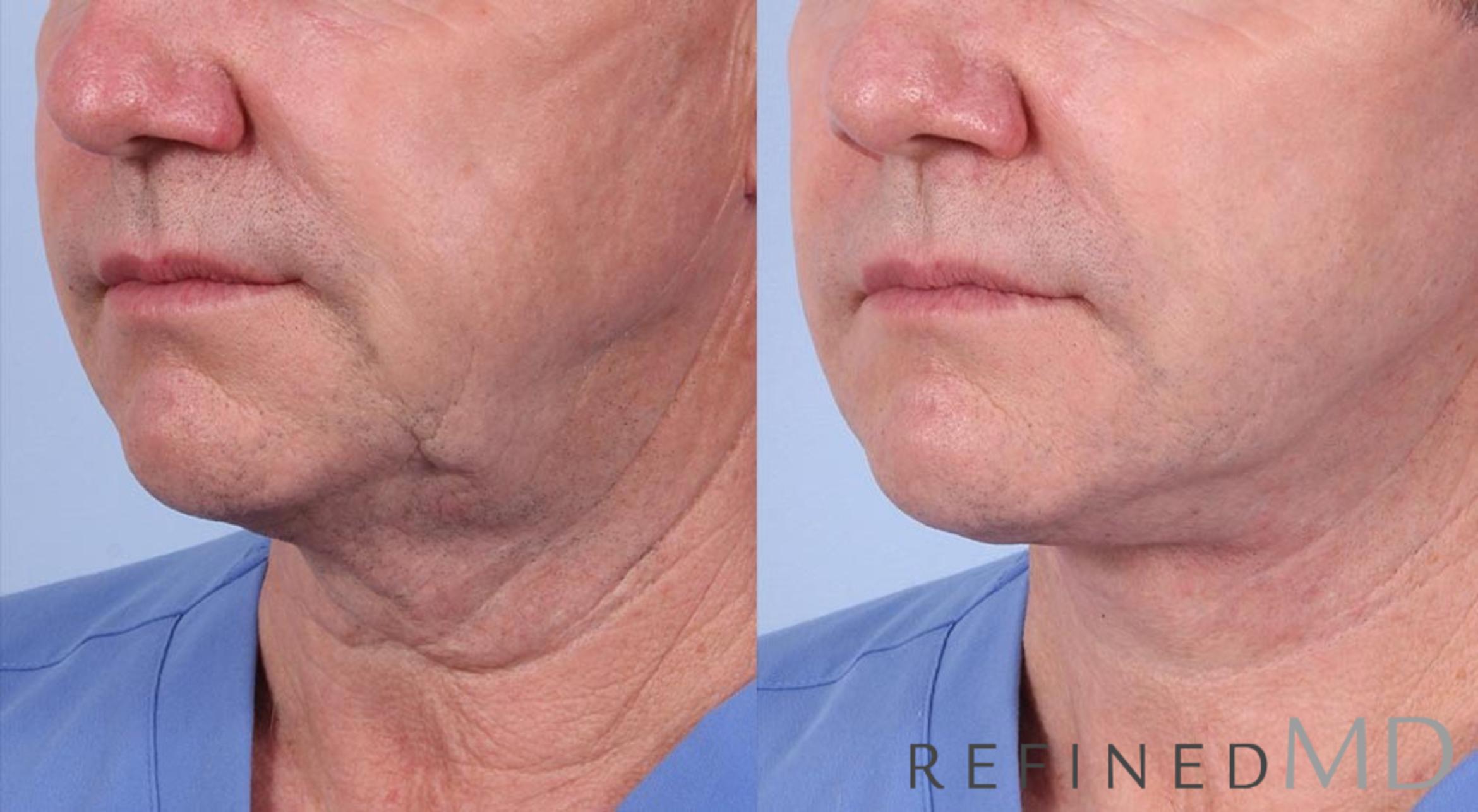 Before & After Facelift Case 1008 View 2 View in Los Gatos & San Jose, CA