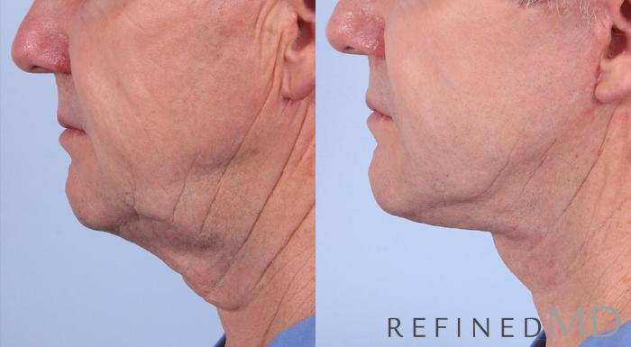 Before & After Facelift Case 1008 View 3 View in Los Gatos & San Jose, CA