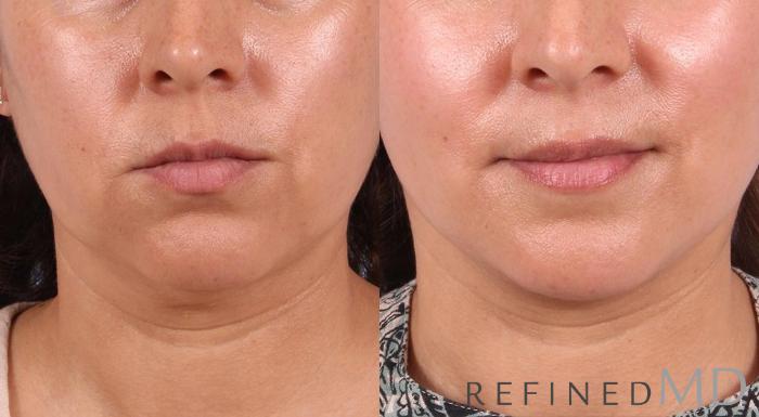 Before & After Facelift Case 1009 View 1 View in Los Gatos & San Jose, CA