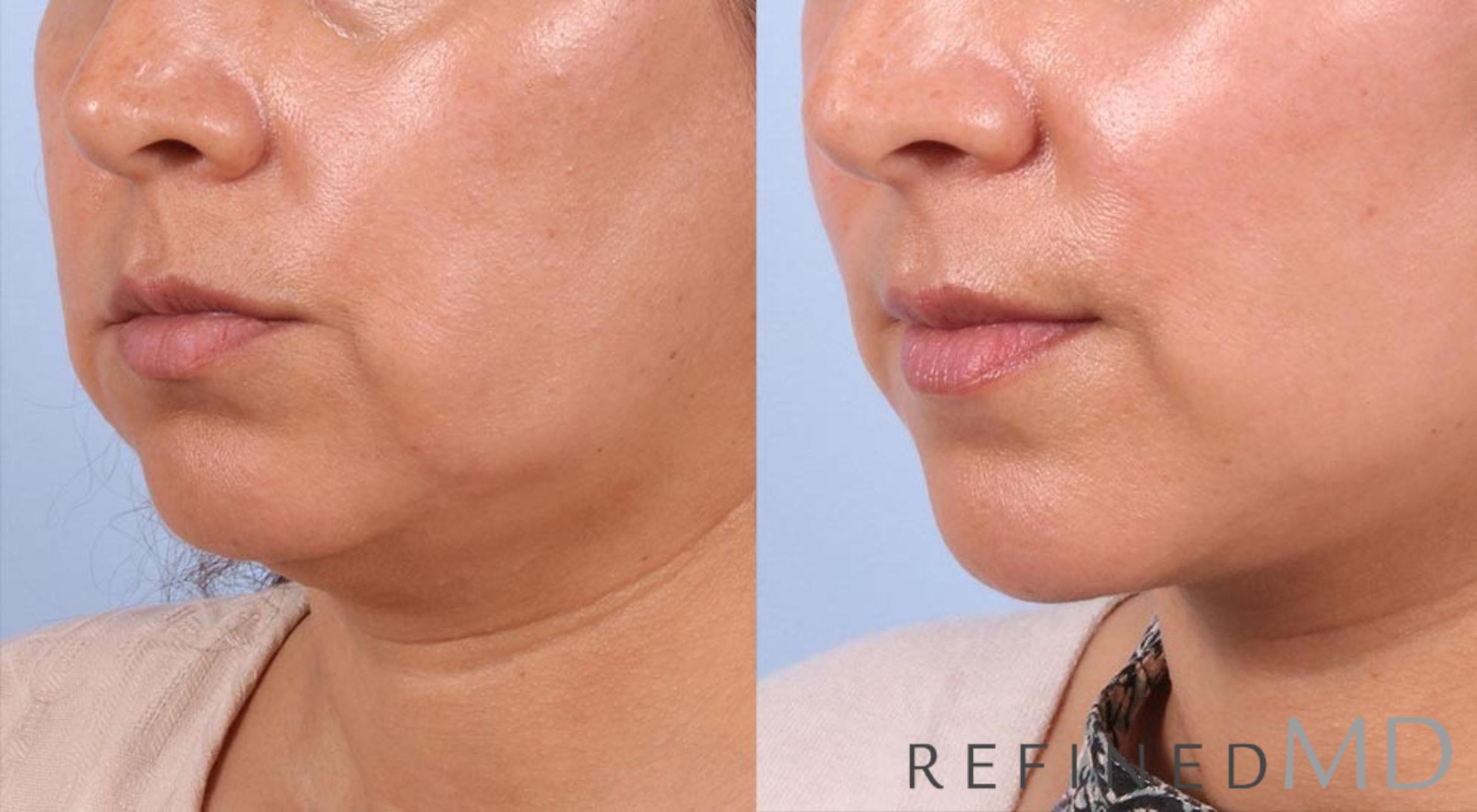 Before & After Facelift Case 1009 View 2 View in Los Gatos & San Jose, CA