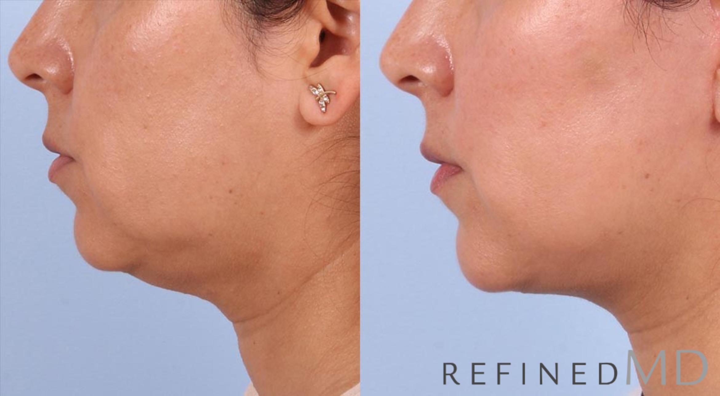 Before & After Facelift Case 1009 View 3 View in Los Gatos & San Jose, CA