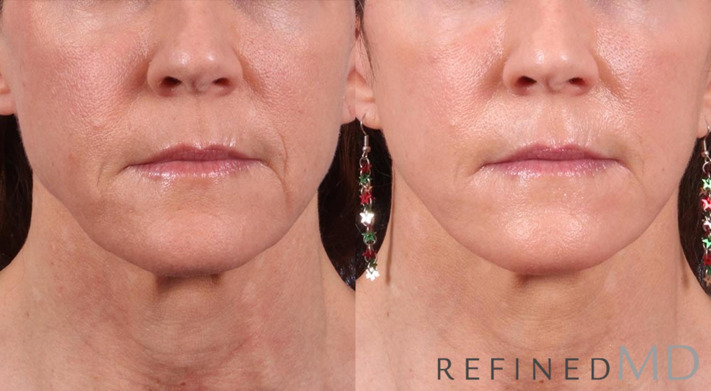 Before & After Facelift Case 1010 View 1 View in Los Gatos & San Jose, CA