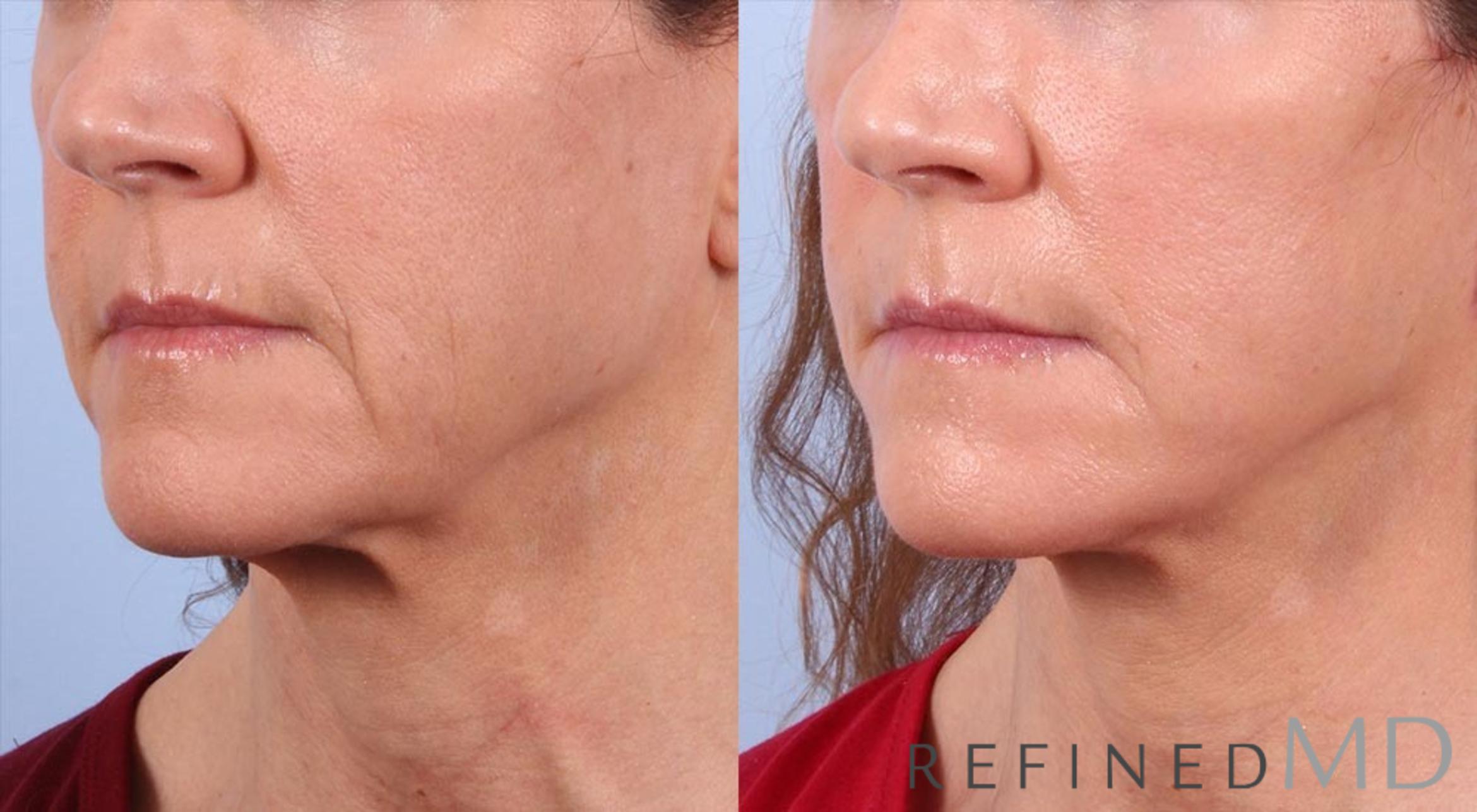 Before & After Facelift Case 1010 View 2 View in Los Gatos & San Jose, CA