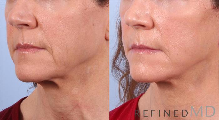 Before & After Facelift Case 1010 View 2 View in Los Gatos & San Jose, CA