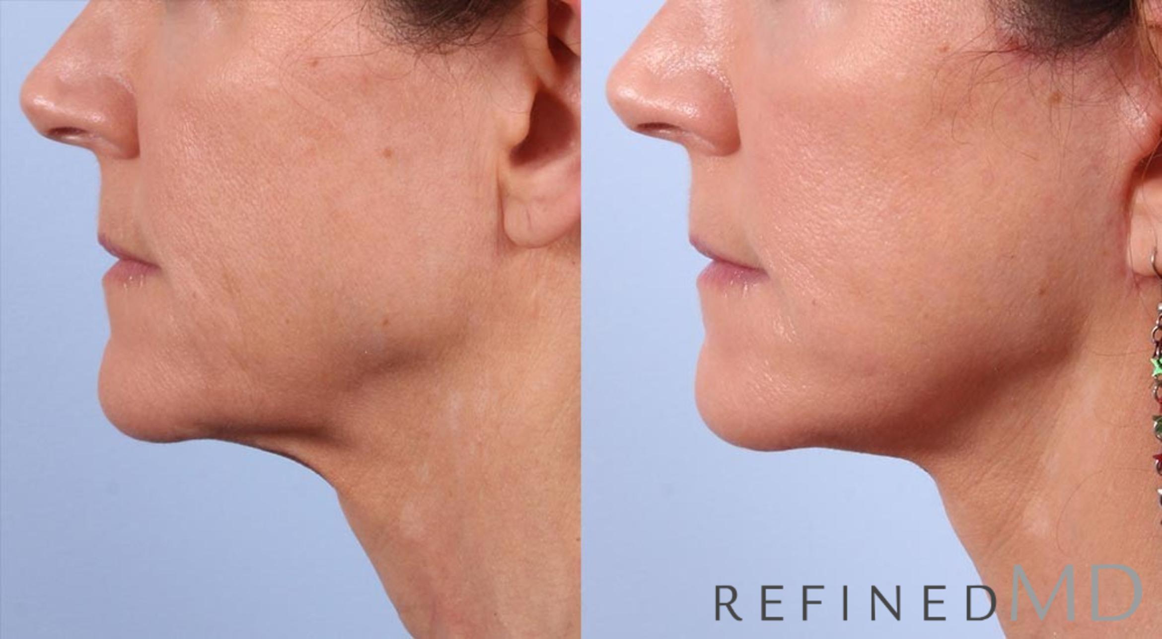 Before & After Facelift Case 1010 View 3 View in Los Gatos & San Jose, CA