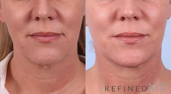 Before & After Facelift Case 1011 View 1 View in Los Gatos & San Jose, CA