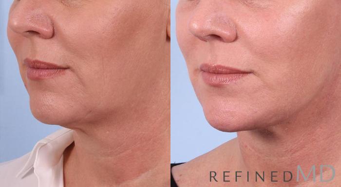 Before & After Facelift Case 1011 View 2 View in Los Gatos & San Jose, CA
