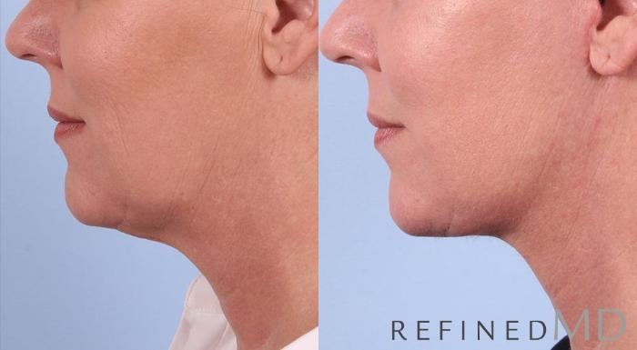 Before & After Facelift Case 1011 View 3 View in Los Gatos & San Jose, CA